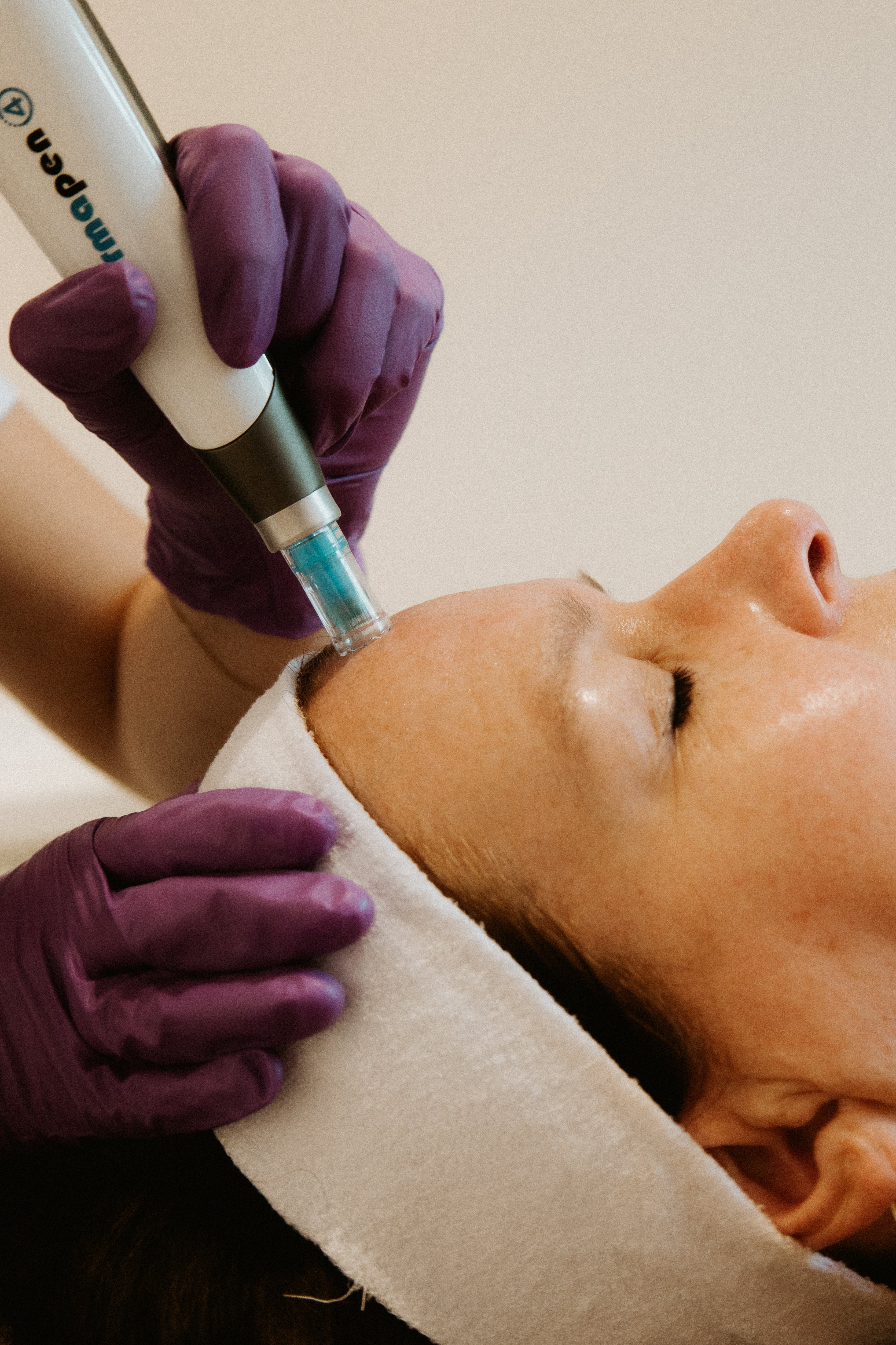 er vindt een Microneedling behandeling plaats waarbij de skin expert het Microneedling apparaat langzaam over de huid laat glijden 